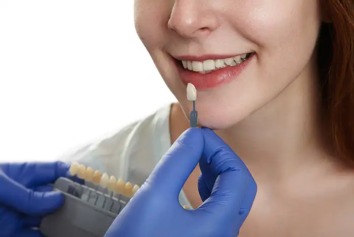 Dental Crowns